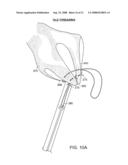 Gastrointestinal implant with drawstring diagram and image