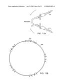 Gastrointestinal implant with drawstring diagram and image