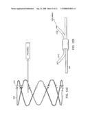 Gastrointestinal implant with drawstring diagram and image