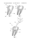 KITS AND METHODS FOR CHAIR-SIDE COATING OF ENDODONTIC CONES diagram and image