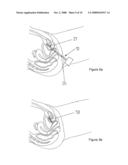 Delivery and Deployment Device For Surgical Web diagram and image