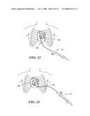 Surgical method and apparatus for treating atrial fibrillation diagram and image