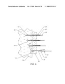 Luminal Structure Anchoring Devices and Methods diagram and image