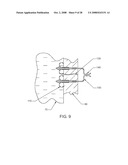 Luminal Structure Anchoring Devices and Methods diagram and image