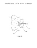 Luminal Structure Anchoring Devices and Methods diagram and image