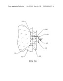 Luminal Structure Anchoring Devices and Methods diagram and image