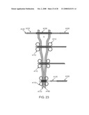 Luminal Structure Anchoring Devices and Methods diagram and image