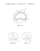 DEVICES USED TO TREAT DISC HERNIATION AND ATTACHMENT MECHANISMS THEREFORE diagram and image