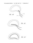 DEVICES USED TO TREAT DISC HERNIATION AND ATTACHMENT MECHANISMS THEREFORE diagram and image