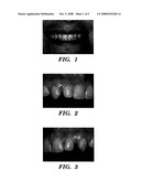 DENTAL COMPOSITES AND PLACEMENT TECHNIQUES FOR DIRECT RESTORATIONS diagram and image