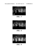 DENTAL COMPOSITES AND PLACEMENT TECHNIQUES FOR DIRECT RESTORATIONS diagram and image