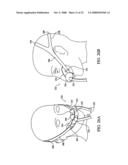 Patient Interface Device diagram and image