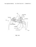 ORTHOVOLTAGE RADIOSURGERY diagram and image