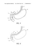 Therapeutic method and therapeutic system that use overtube with balloons diagram and image