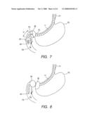 Therapeutic method and therapeutic system that use overtube with balloons diagram and image