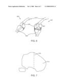 METHOD FOR IMPROVED ROTATIONAL ALIGNMENT IN JOINT ARTHROPLASTY diagram and image