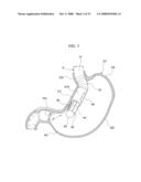 GASTRIC THERAPY SYSTEM AND METHOD FOR SUTURING GASTRIC WALL diagram and image