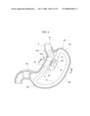 GASTRIC THERAPY SYSTEM AND METHOD FOR SUTURING GASTRIC WALL diagram and image