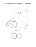 GASTRIC THERAPY SYSTEM AND METHOD FOR SUTURING GASTRIC WALL diagram and image