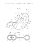 GASTRIC THERAPY SYSTEM AND METHOD FOR SUTURING GASTRIC WALL diagram and image