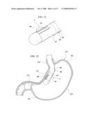 GASTRIC THERAPY SYSTEM AND METHOD FOR SUTURING GASTRIC WALL diagram and image