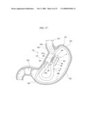 GASTRIC THERAPY SYSTEM AND METHOD FOR SUTURING GASTRIC WALL diagram and image