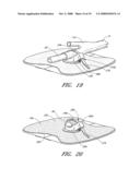 Anchoring System For a Catheter diagram and image