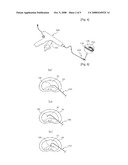 Radio Frequency Ablation Electrode for Selected Tissue Removal diagram and image