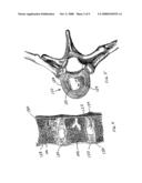 Dual incision disc repair device and method diagram and image