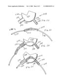 Dual incision disc repair device and method diagram and image