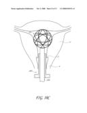 METHOD AND DEVICE FOR DISTENDING A GYNECOLOGICAL CAVITY diagram and image