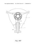 METHOD AND DEVICE FOR DISTENDING A GYNECOLOGICAL CAVITY diagram and image