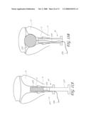 METHOD AND DEVICE FOR DISTENDING A GYNECOLOGICAL CAVITY diagram and image