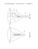 METHOD AND DEVICE FOR DISTENDING A GYNECOLOGICAL CAVITY diagram and image