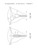 METHOD AND DEVICE FOR DISTENDING A GYNECOLOGICAL CAVITY diagram and image