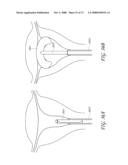 METHOD AND DEVICE FOR DISTENDING A GYNECOLOGICAL CAVITY diagram and image