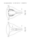 METHOD AND DEVICE FOR DISTENDING A GYNECOLOGICAL CAVITY diagram and image