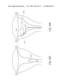 METHOD AND DEVICE FOR DISTENDING A GYNECOLOGICAL CAVITY diagram and image