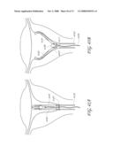 METHOD AND DEVICE FOR DISTENDING A GYNECOLOGICAL CAVITY diagram and image