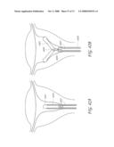 METHOD AND DEVICE FOR DISTENDING A GYNECOLOGICAL CAVITY diagram and image