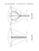 METHOD AND DEVICE FOR DISTENDING A GYNECOLOGICAL CAVITY diagram and image