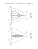 METHOD AND DEVICE FOR DISTENDING A GYNECOLOGICAL CAVITY diagram and image