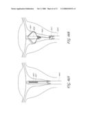 METHOD AND DEVICE FOR DISTENDING A GYNECOLOGICAL CAVITY diagram and image