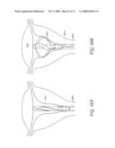 METHOD AND DEVICE FOR DISTENDING A GYNECOLOGICAL CAVITY diagram and image