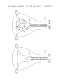 METHOD AND DEVICE FOR DISTENDING A GYNECOLOGICAL CAVITY diagram and image