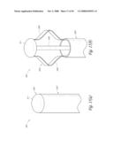 METHOD, SYSTEM AND DEVICE FOR TISSUE REMOVAL diagram and image