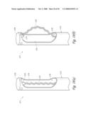 METHOD, SYSTEM AND DEVICE FOR TISSUE REMOVAL diagram and image