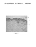 TREATMENT OF ALOPECIA BY MICROPORE DELIVERY OF STEM CELLS diagram and image