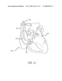 DIAGNOSTIC CATHETER diagram and image