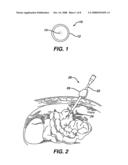 SENTINEL NODE IDENTIFICATION USING FLUORESCENT NANOPARTICLES diagram and image